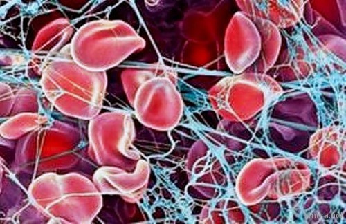 Цветной микроснимок сканирующего электронного микроскопа (СЭМ) красных кровяных клеток (эритроцитов) застрявших сетях фибрина (голубой). Когда кровеносные сосуды повреждаются, тромбоциты активизируются и провоцируют выработку фибрина. Фибрин задерживает в себе различные кровяные тельца, формируя твердую структуру называемую сгустком крови. Свертываемость крови является нормальной реакцией, предотвращающей излишнюю потерю крови. Однако, неуместное образование сгустков есть основная причина сердечных приступов и инсультов.