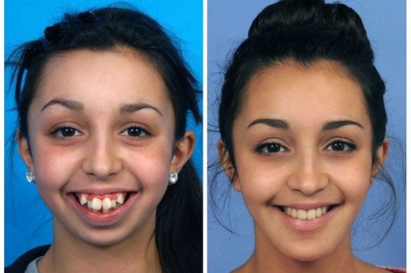 Невероятное преображение девушки после пластической коррекции челюсти