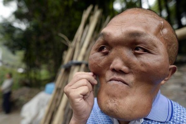 В Китае живет человек с "лицом инопланетянина"