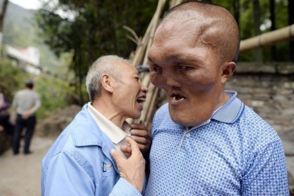 В Китае живет человек с "лицом инопланетянина"