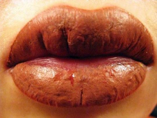  Болезненный процесс татуажа губ